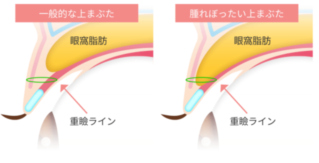 埋没法って取れるの？