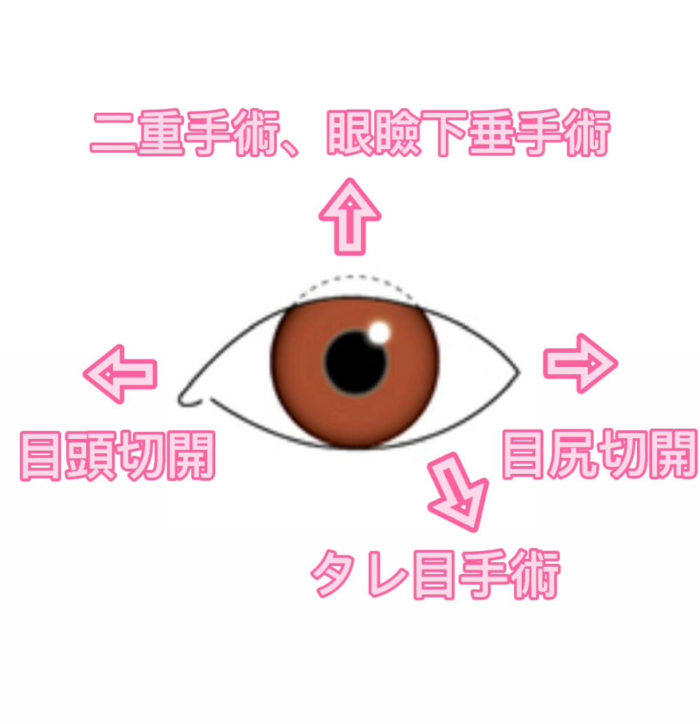 つり目を治すだけじゃない！？目を大きく見せる当院でのタレ目形成術（グラマラスライン形成術）