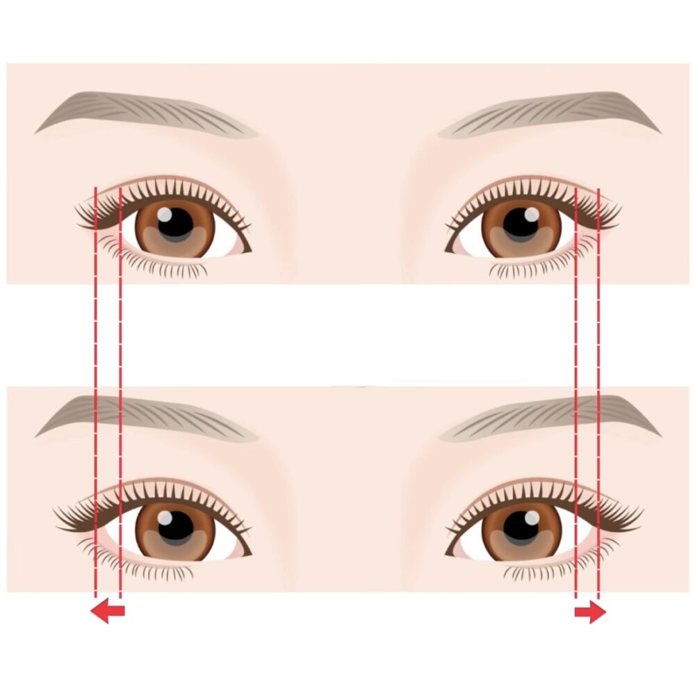 目尻切開で目は大きくなるの！？当院の目尻切開の方法