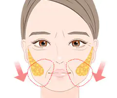 バッカルファット