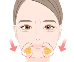 ジョールファット除去