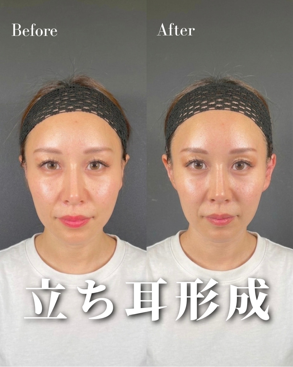 立ち耳ヒアルの症例解説②(片耳の軟骨を採取している場合)