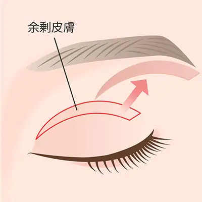 ⼆重整形 (切開法)