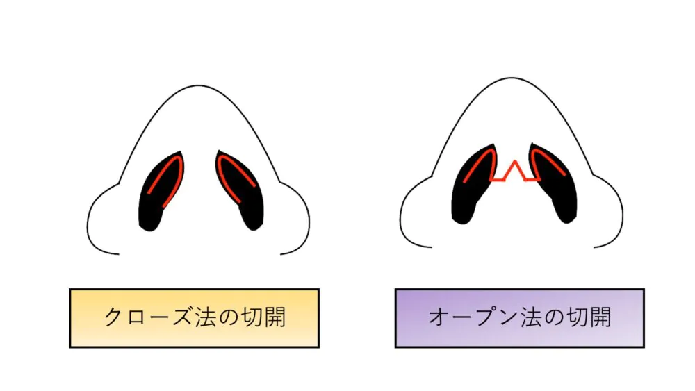 オープン法の傷痕は綺麗に消えるのか？   