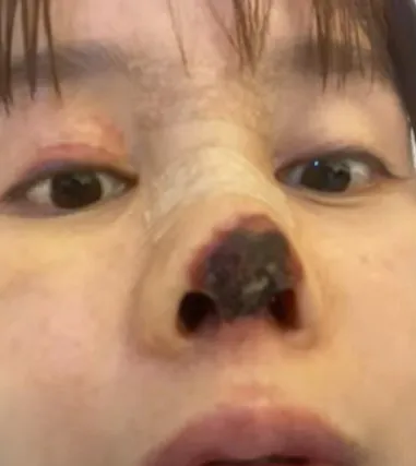 鼻先のヒアルロン酸って安全なの？