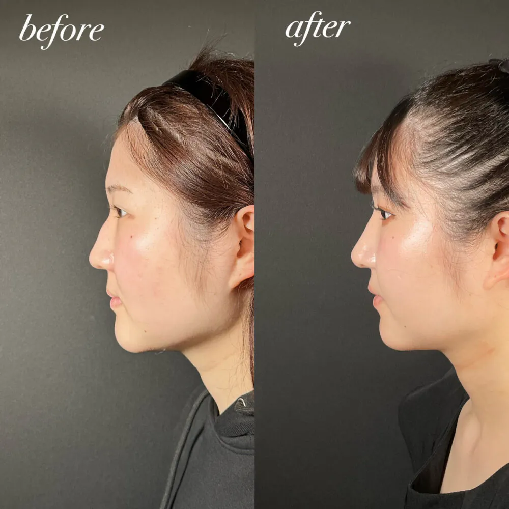 わし鼻修正！症例を用いて解説します(^^)/