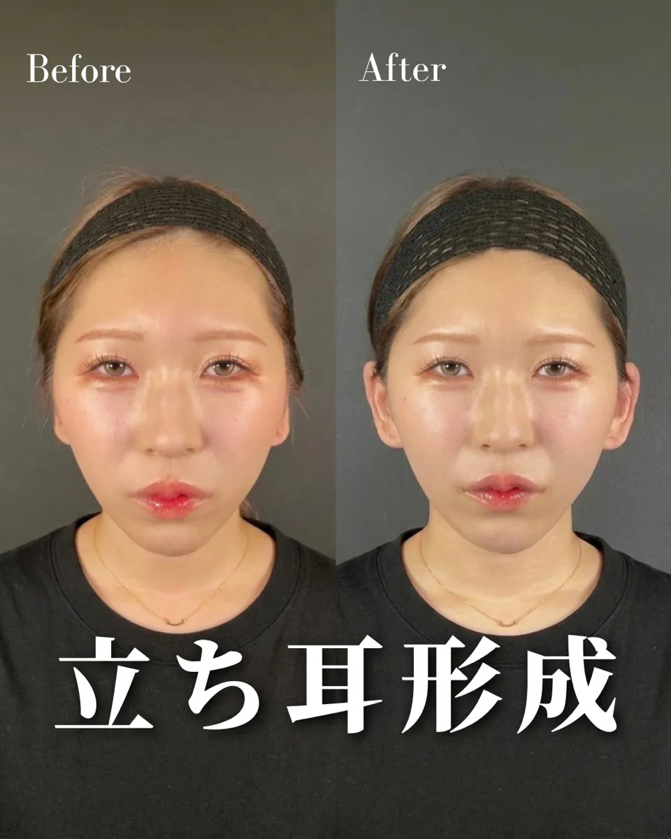 立ち耳ヒアル、症例①　解説します！！