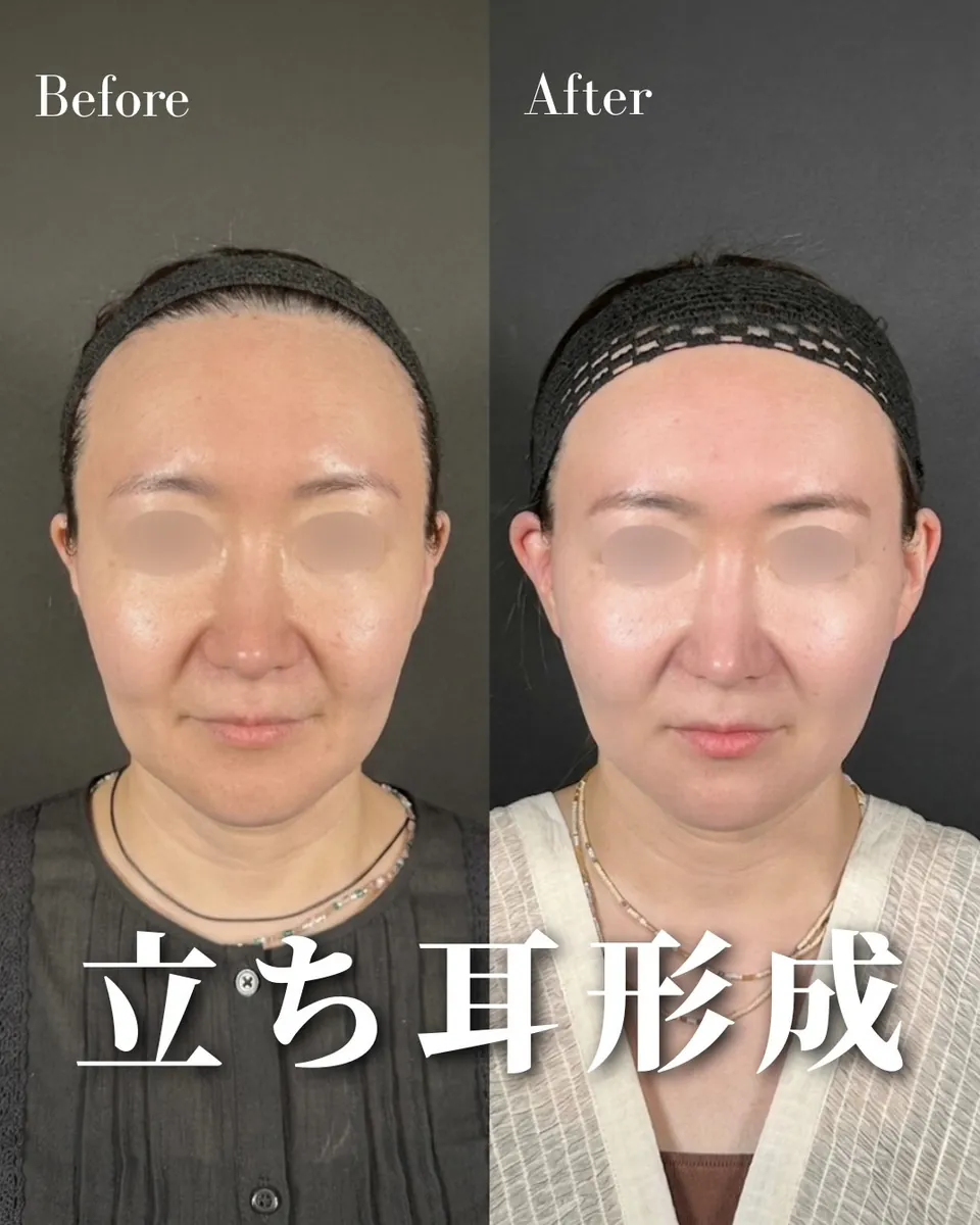 立ち耳にする美容施術って？？